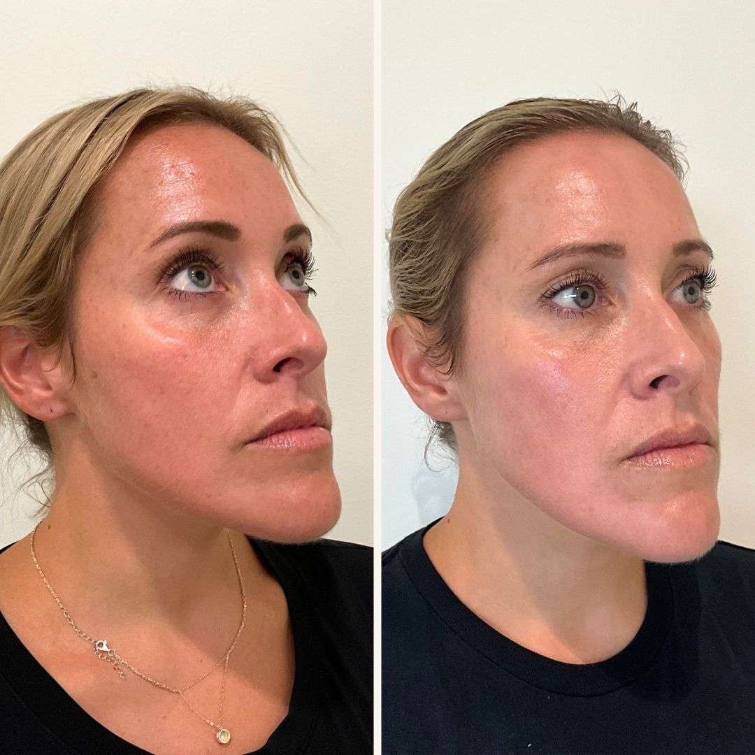 BBL Heroic before and after Wilmington NC