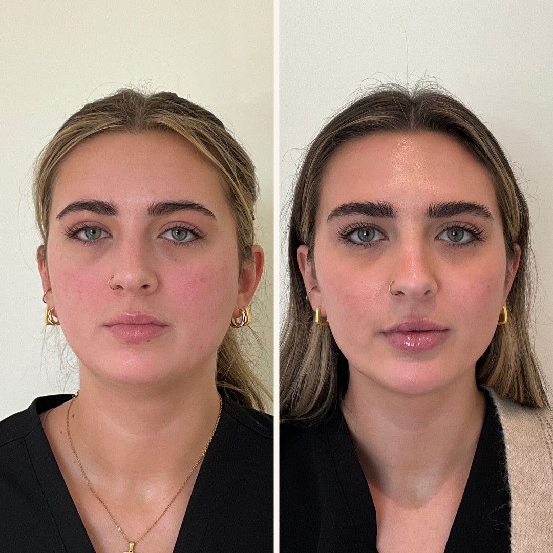 Full facial balancing before and after photo in Wilmington, NC