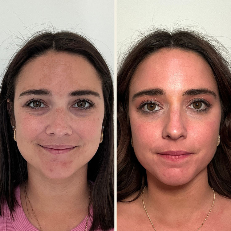 Sciton Moxi results in Wilmington NC