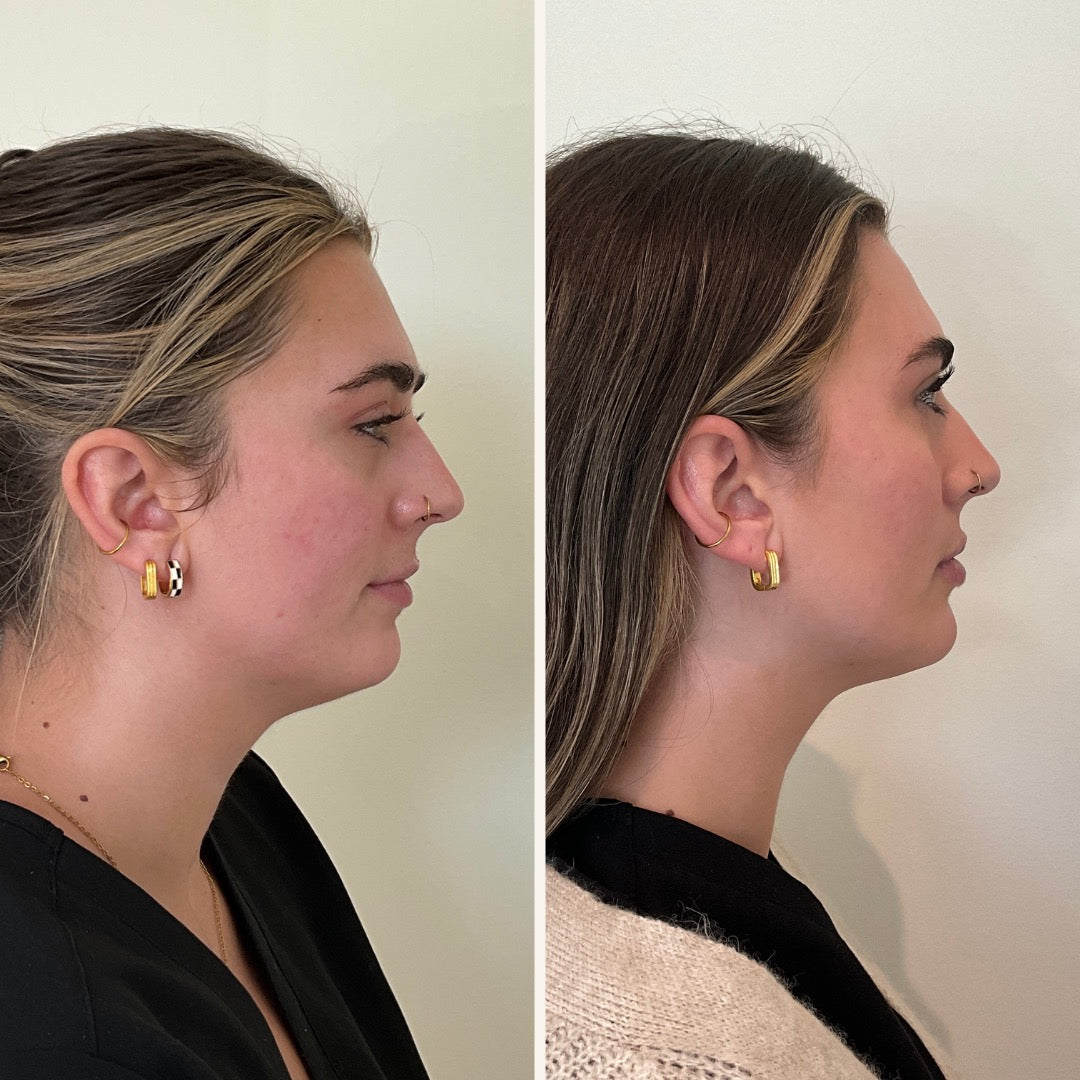 Lip filler in Wilmington, NC