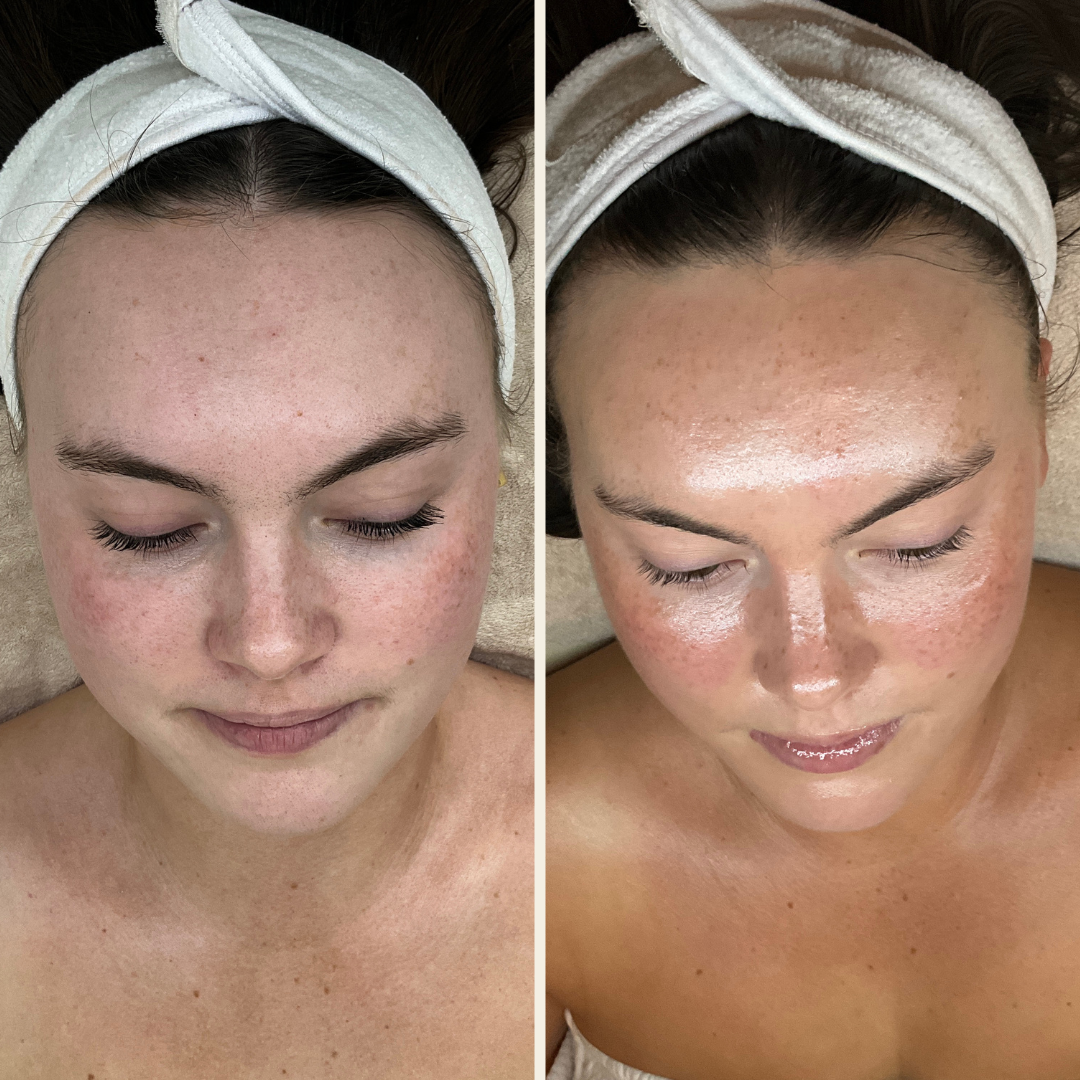 Hydrafacial results in Wilmington, NC