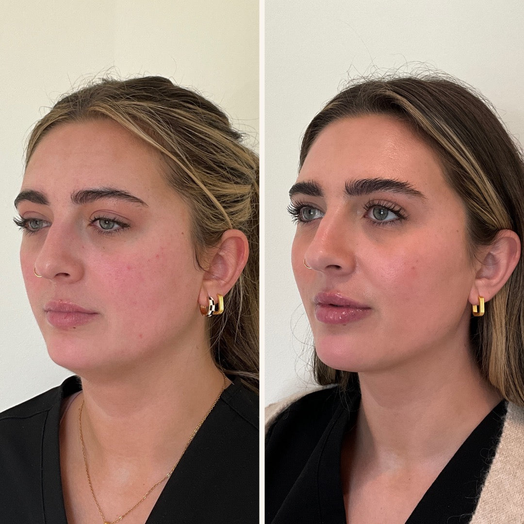 Lip filler in Wilmington, NC