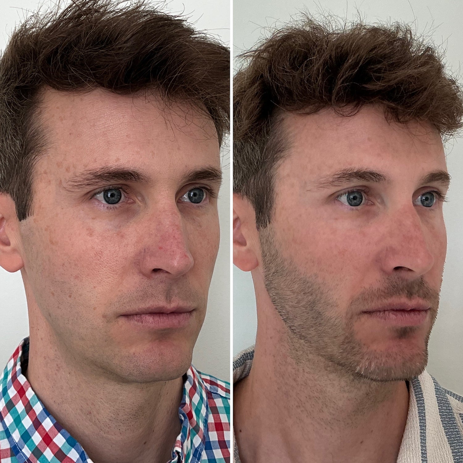 PRP results in Wilmington, NC