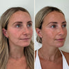 Full facial balancing before and after photo