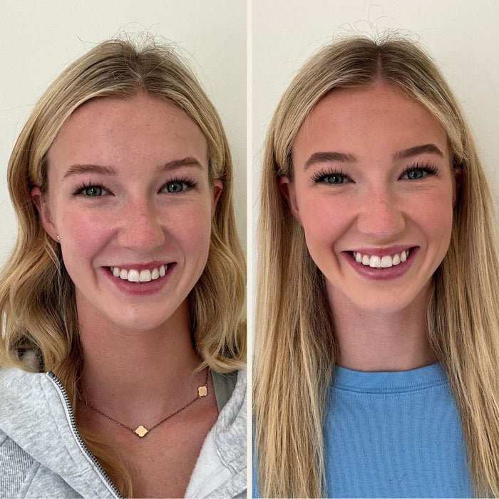 Lip Flip Before and After Photo at Self Skin Studio in Wilmington, NC