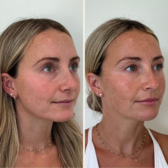 Full facial balancing before and after photo in Wilmington, NC