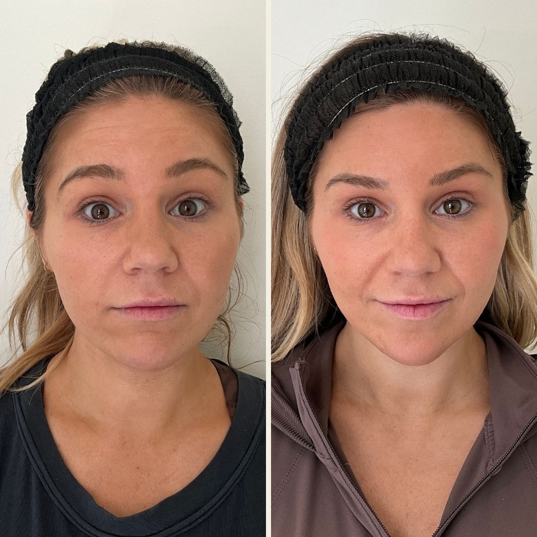 Botox for masseters before and after results at Self Skin Studio in Wilmington NC