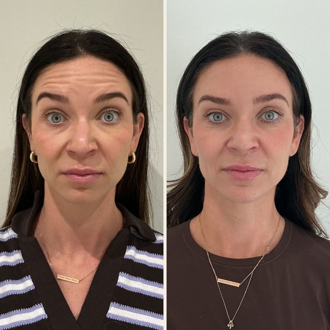 Botox before and after results at Self Skin Studio in Wilmington NC