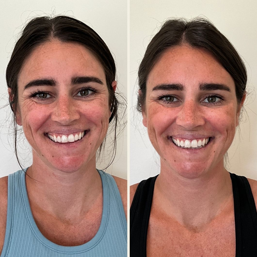 Botox before and after results at Self Skin Studio in Wilmington NC