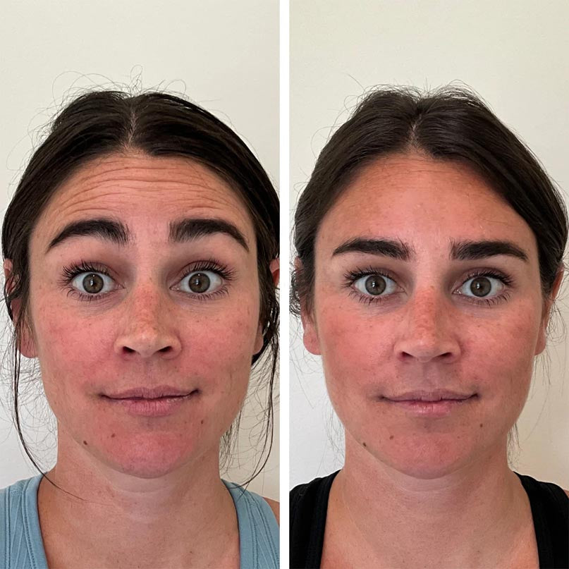 Botox before and after photo at Self Skin Studio in Wrightsville Beach and Wilmington, NC