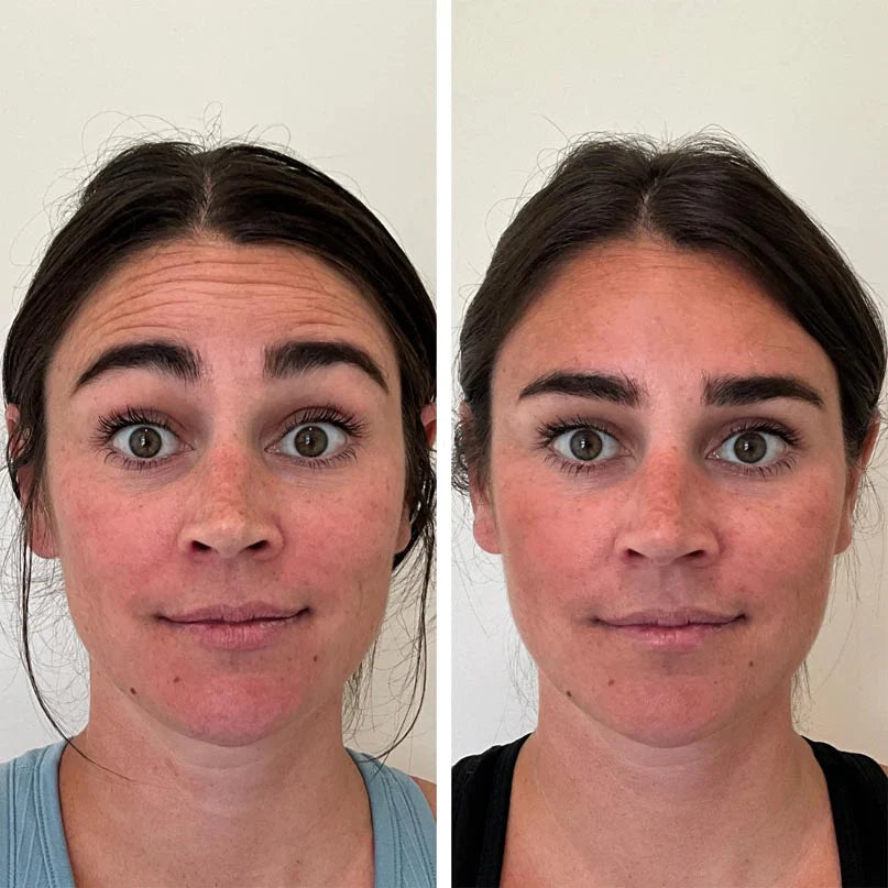 Botox before and after photo in Wilmington, NC