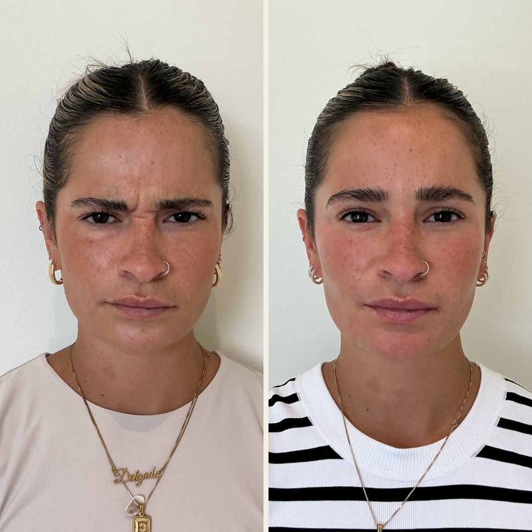 Daxxify before and after results at Self Skin Studio in Wilmington NC