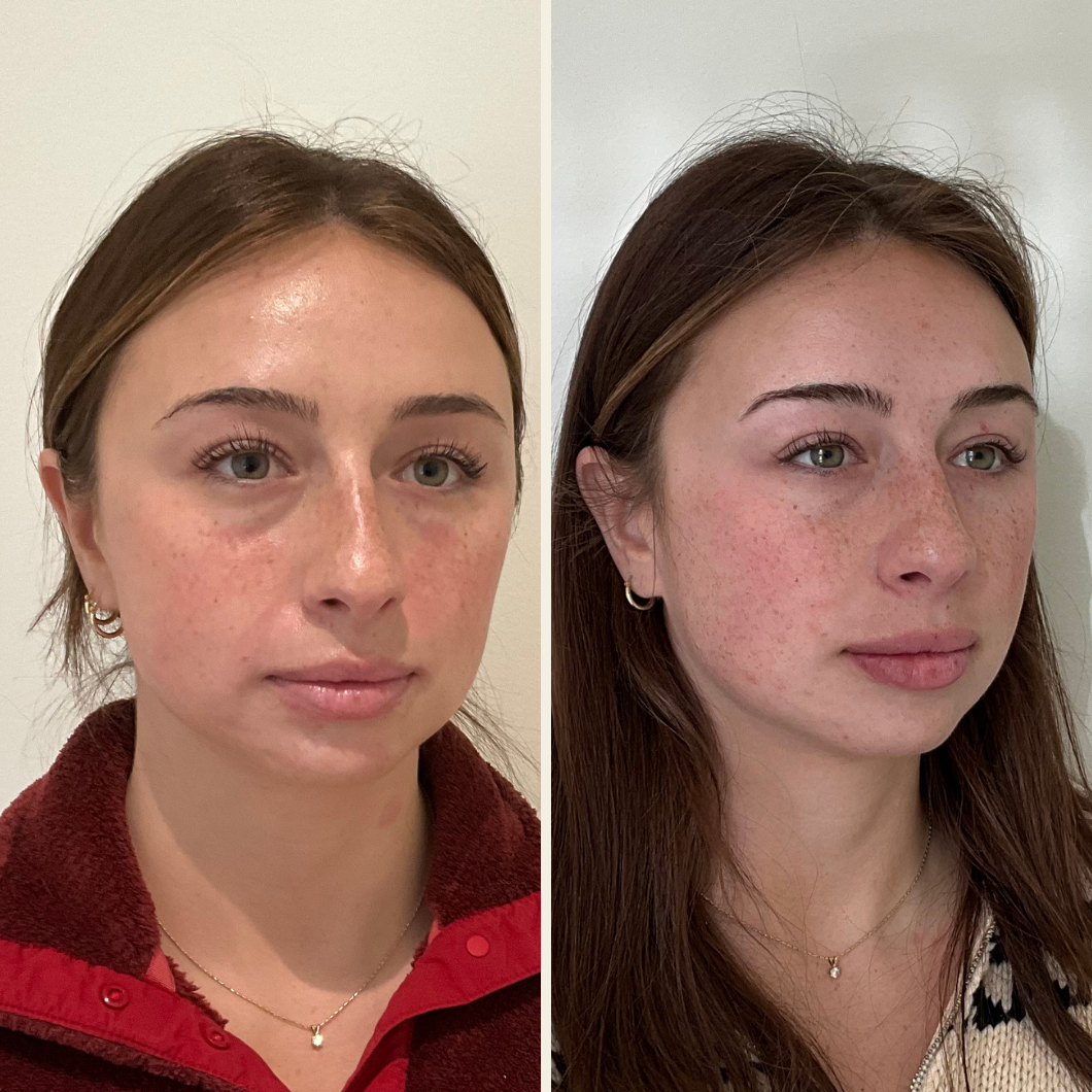 dermal filler results at Self Skin Studio in Wilmington, NC