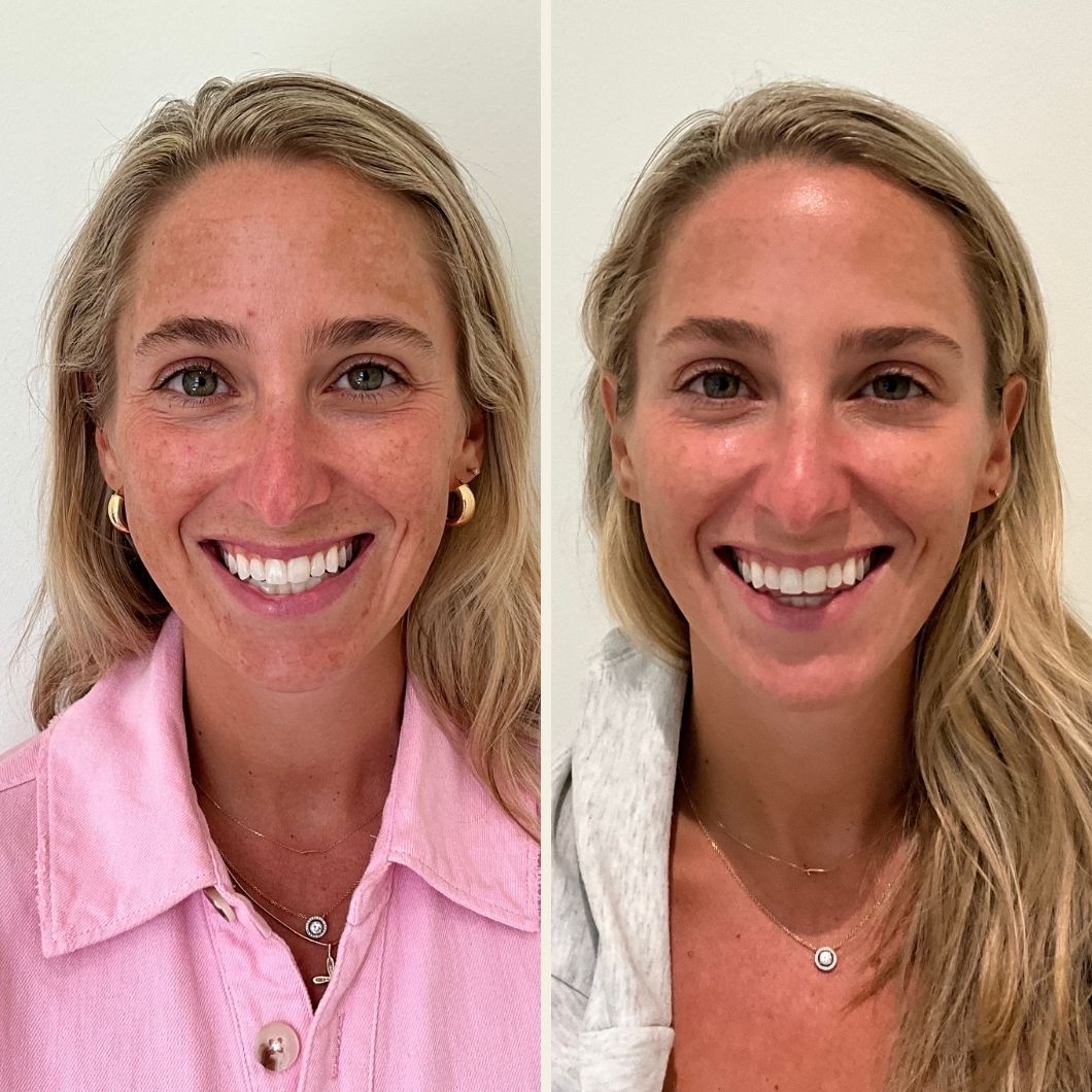 Dysport before and after results at Self Skin Studio in Wilmington NC