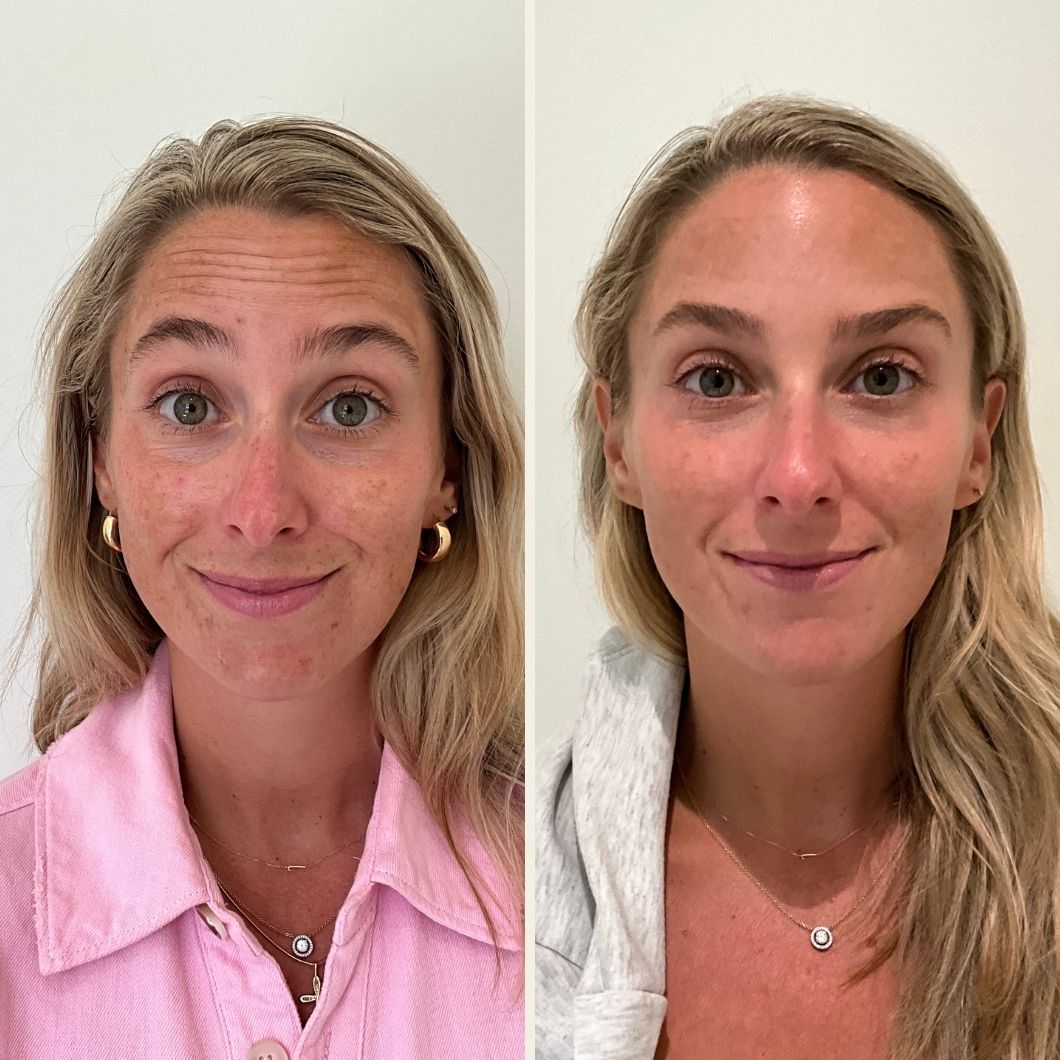 Dysport before and after results at Self Skin Studio in Wilmington NC