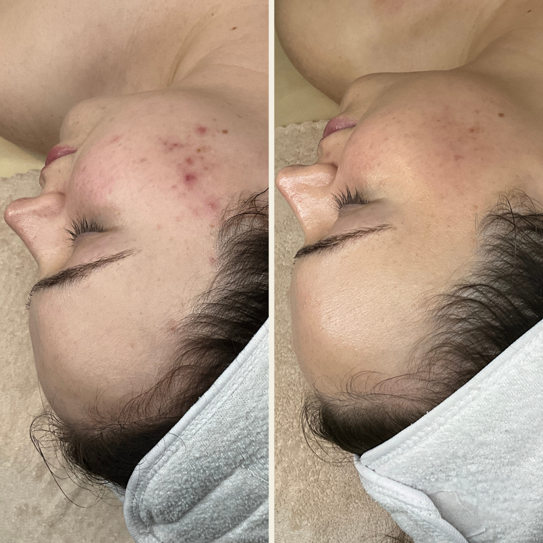 facial before and after photo