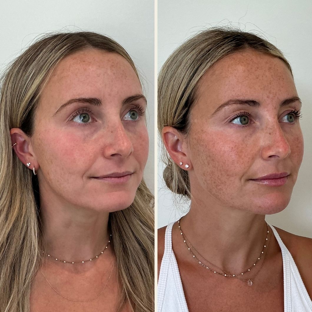 Full facial balancing results in Wilmington, NC