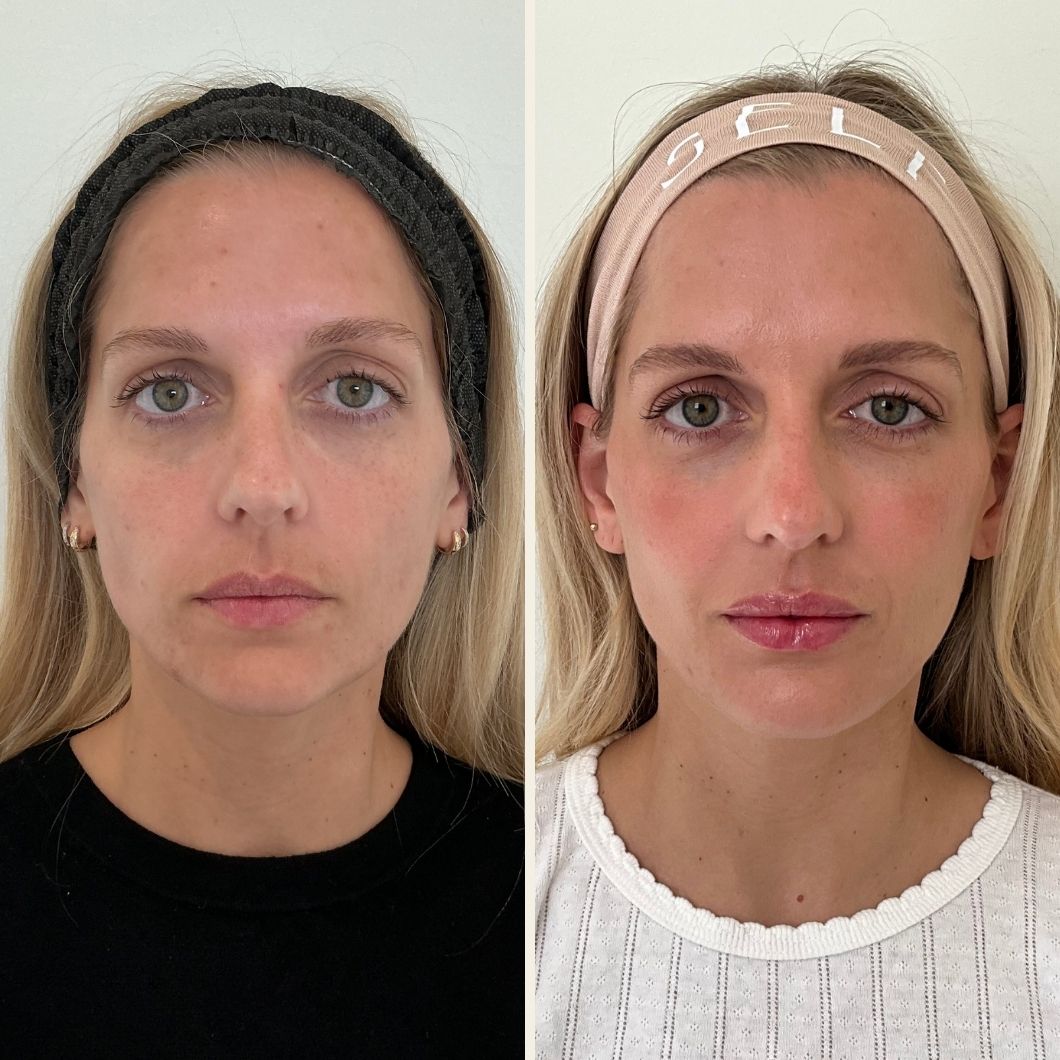 Full facial balancing results in Wilmington, NC