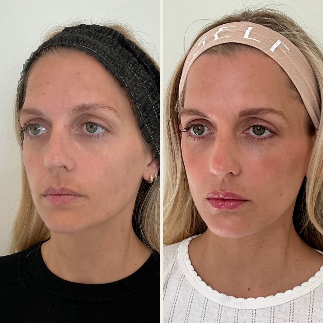 Full facial balancing results in Wilmington, NC