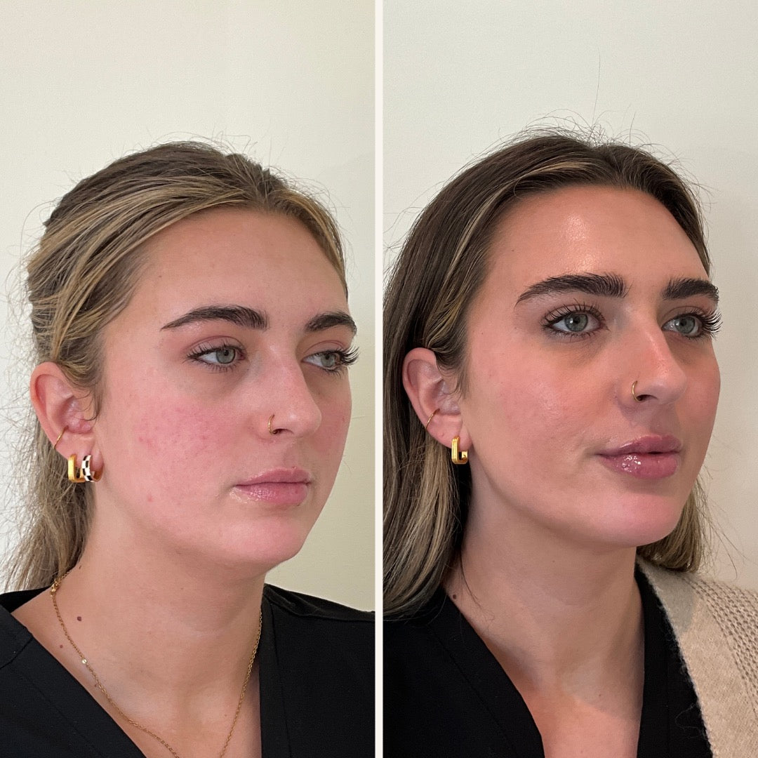 Full facial balancing before and after at Self Skin Studio in Wilmington, NC and Hampstead, NC
