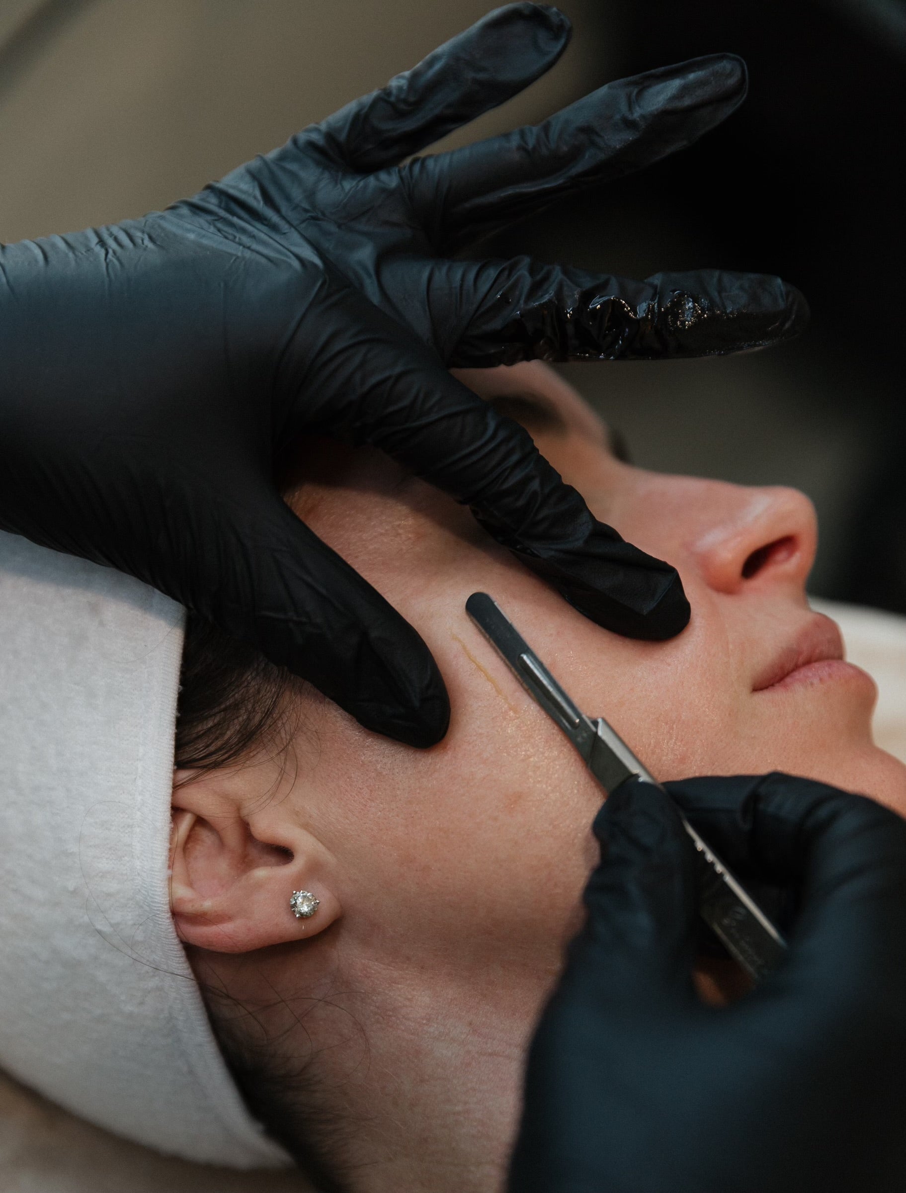 Microneedling in Wilmington, NC