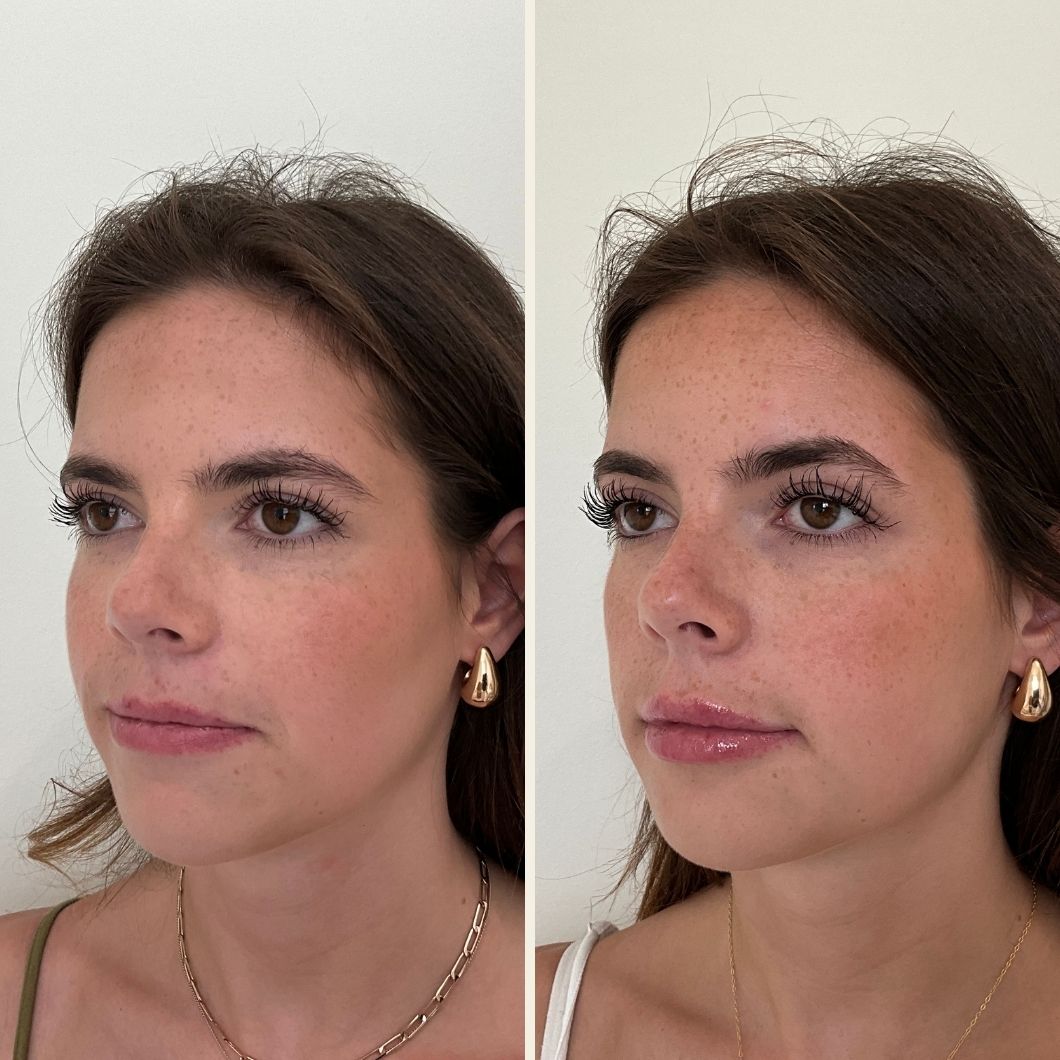 Lip filler before and after results at Self Skin Studio in Wilmington NC