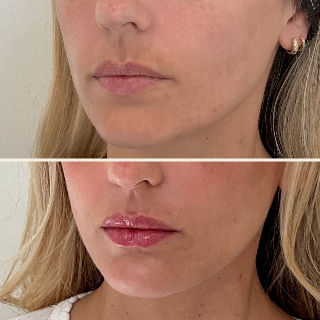 Lip filler before and after results at Self Skin Studio in Wilmington NC