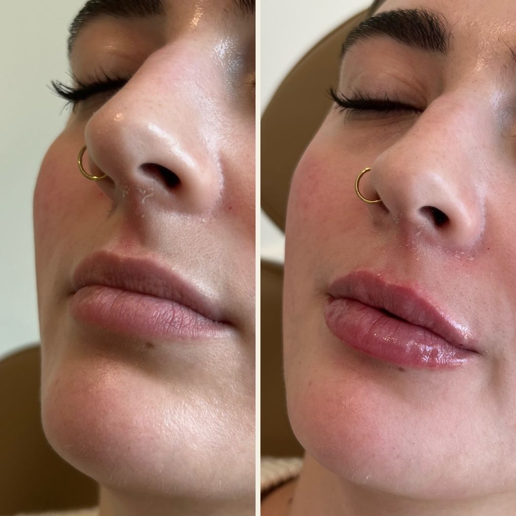 Lip filler before and after results at Self Skin Studio in Wilmington NC