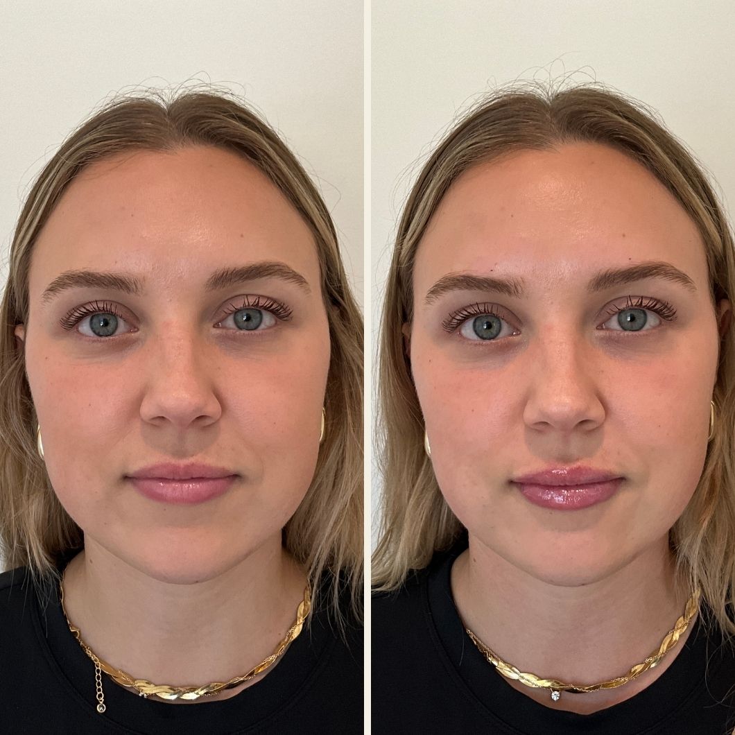 Lip filler before and after results at Self Skin Studio in Wilmington NC