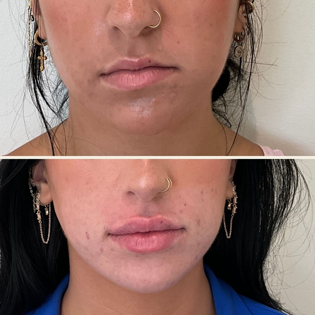 Lip filler before and after results at Self Skin Studio in Wilmington NC