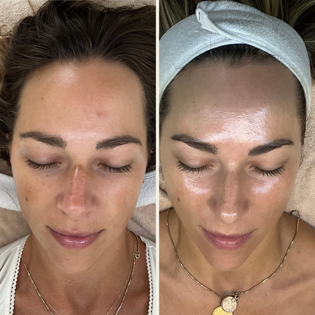 before and after of microneedling results at Self Skin Studio in Wilmington, NC