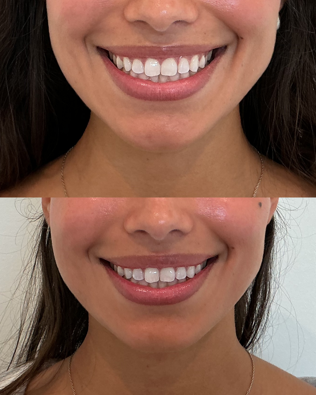 Botox Lip flip at Self Skin Studio in Wilmington, NC