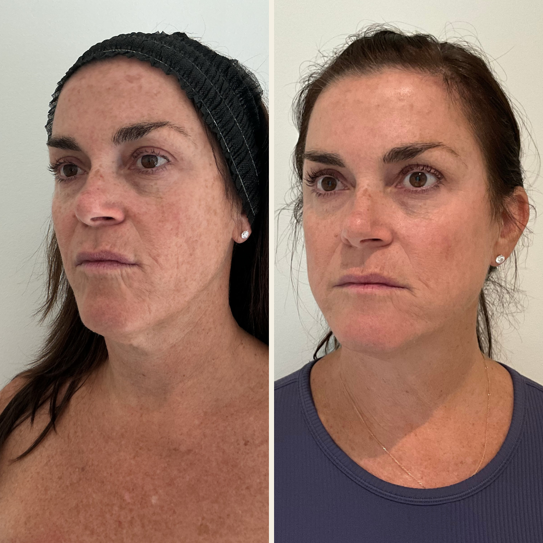 Sciton BBL Heroic and Moxi laser results at Self Skin Studio in Wilmington, NC