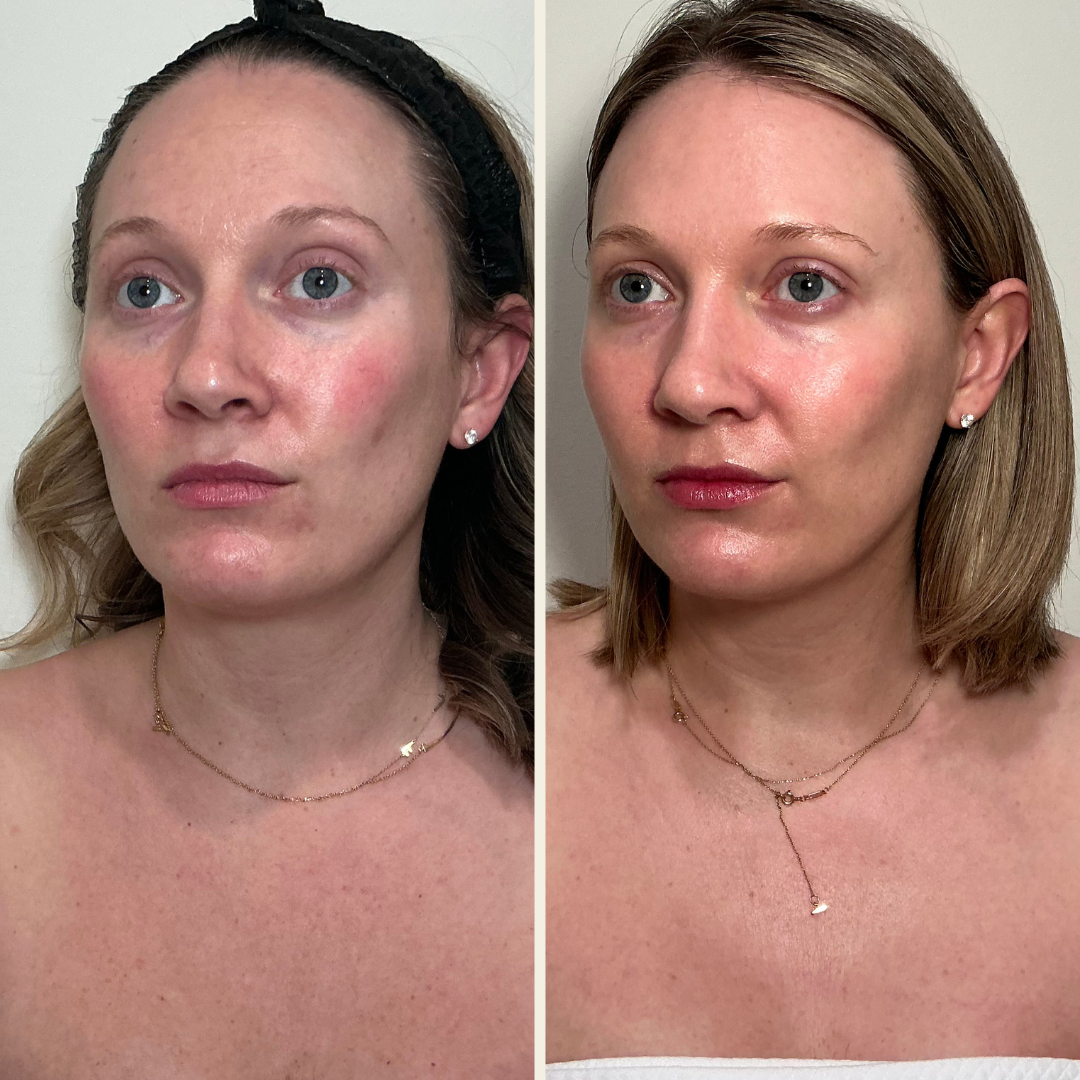 Sciton BBL Heroic and Moxi laser results at Self Skin Studio in Wilmington, NC