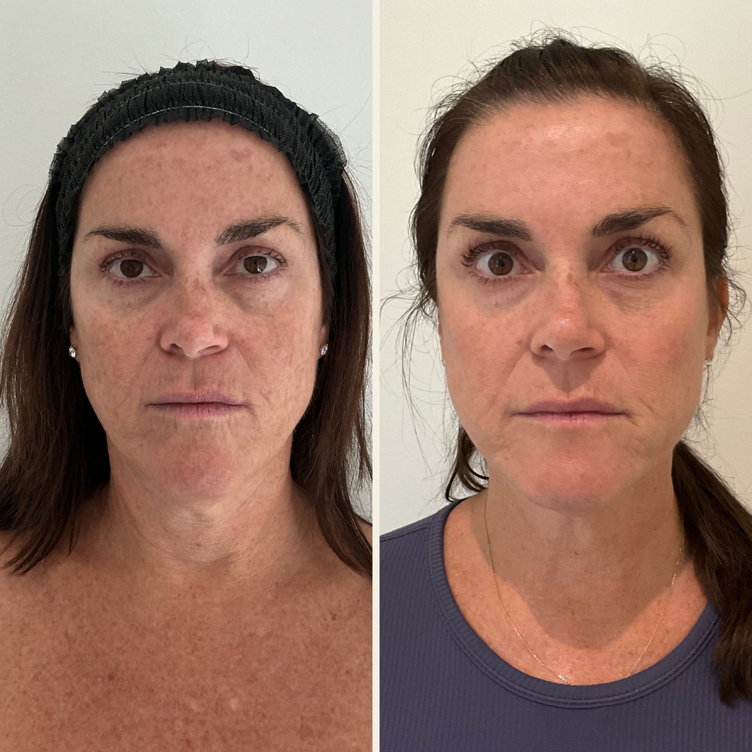 Sciton BBL Heroic and Moxi laser results at Self Skin Studio in Wilmington, NC