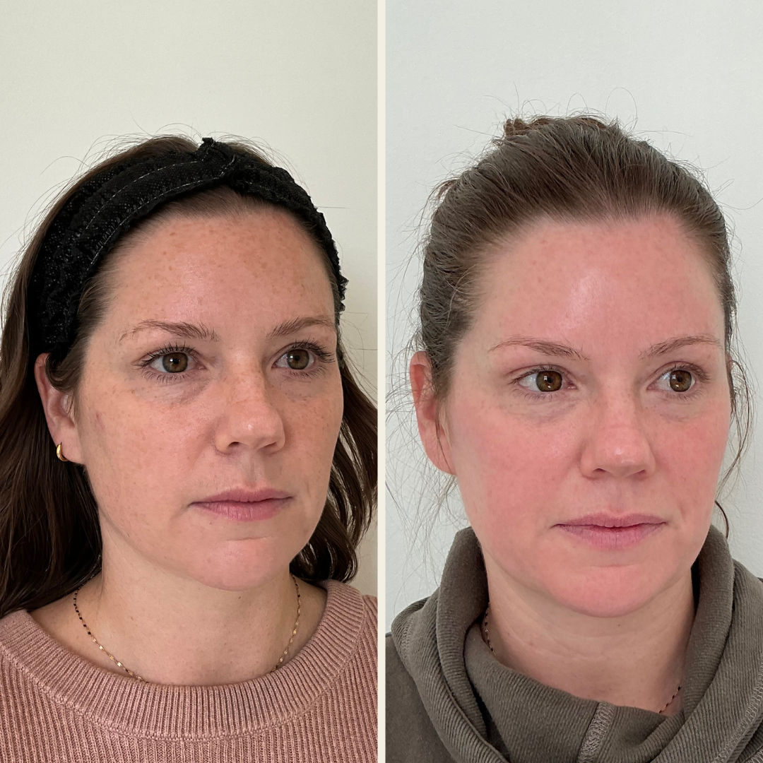 Sciton BBL Heroic and Moxi laser results at Self Skin Studio in Wilmington, NC