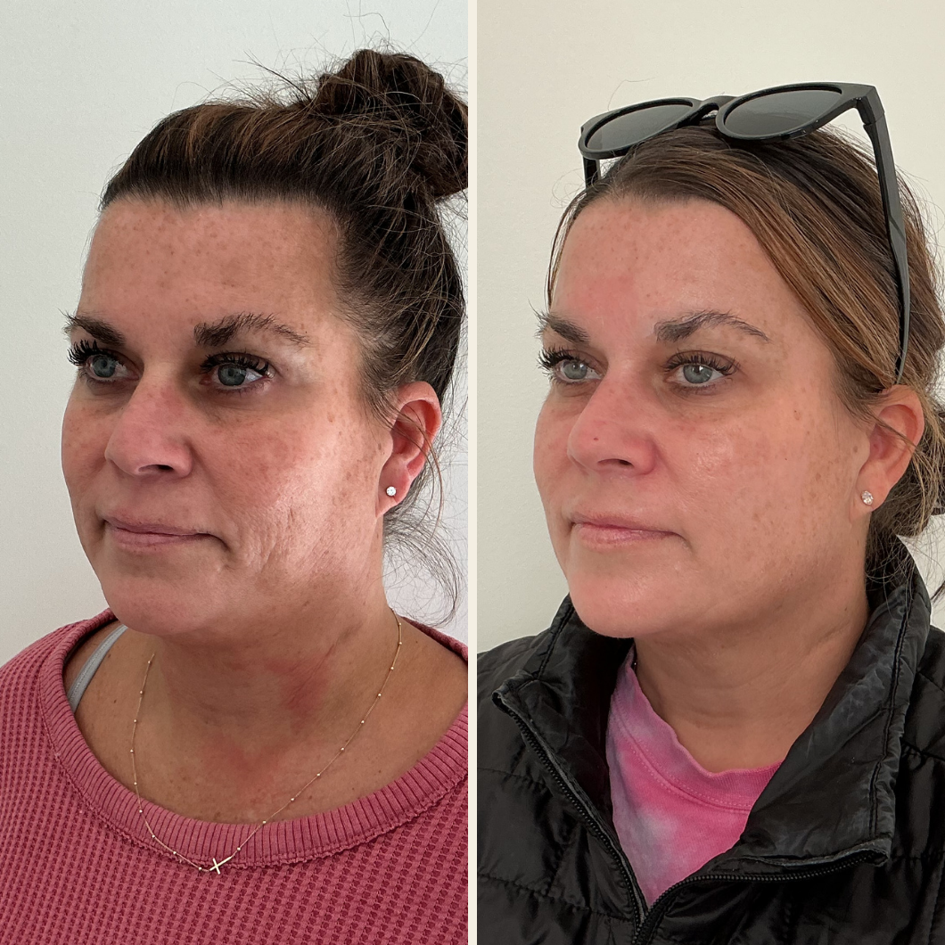 Moxi results at Self Skin Studio in Wilmington, NC