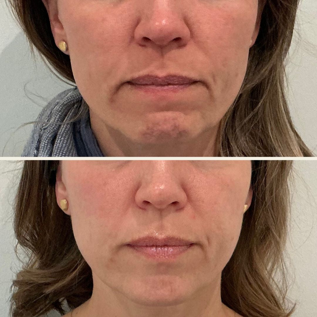 Sculptra results at Self Skin Studio in Wilmington, NC