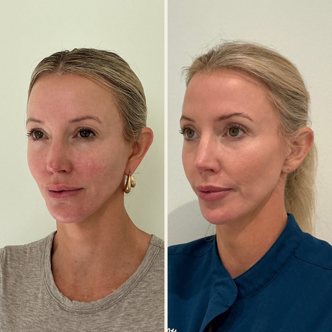 Sculptra results at Self Skin Studio in Wilmington, NC
