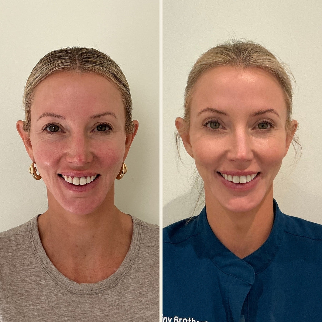 Sculptra results at Self Skin Studio in Wilmington, NC