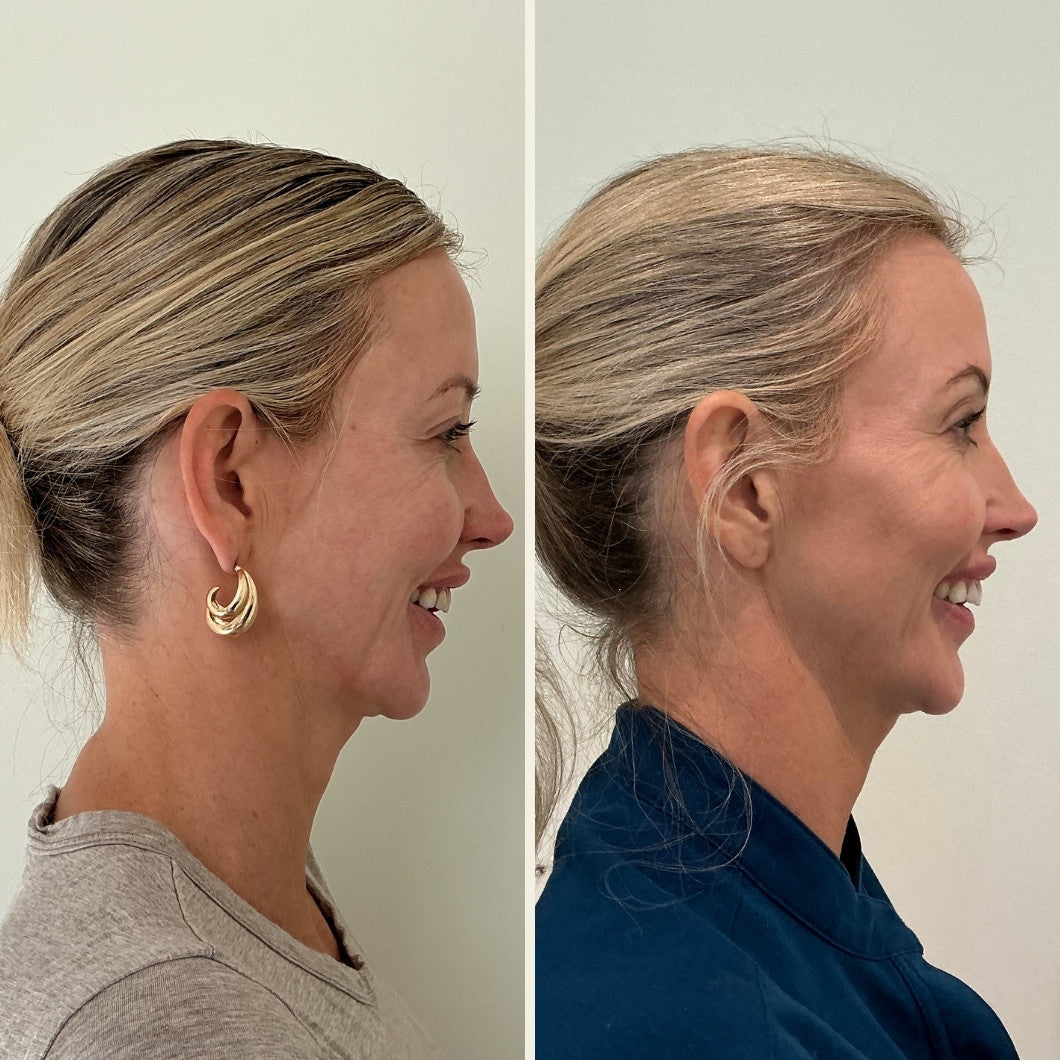 Sculptra results at Self Skin Studio in Wilmington, NC