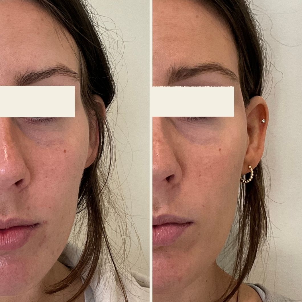 temple filler results at Self Skin Studio in Wilmington, NC