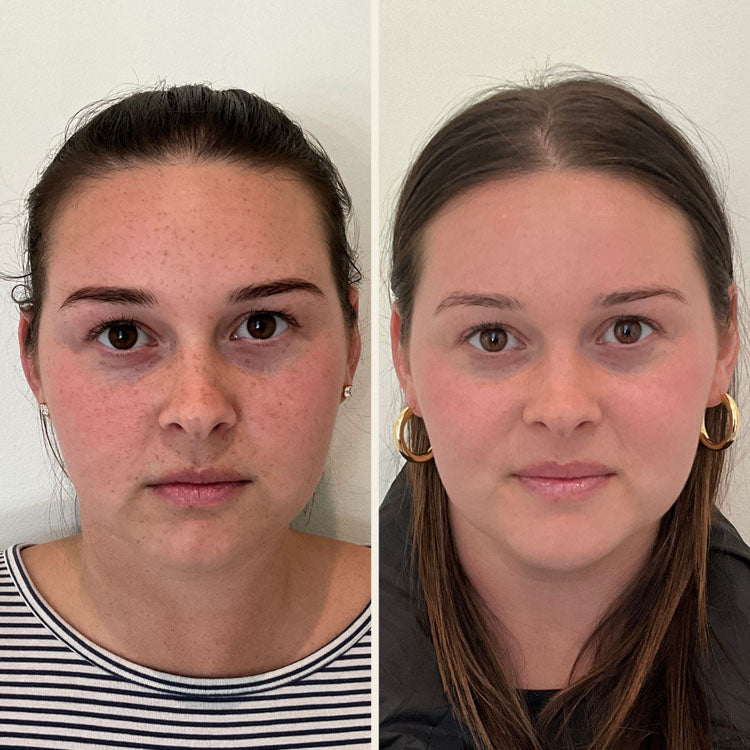 BBL Moxi Treatment - Before & After Photo