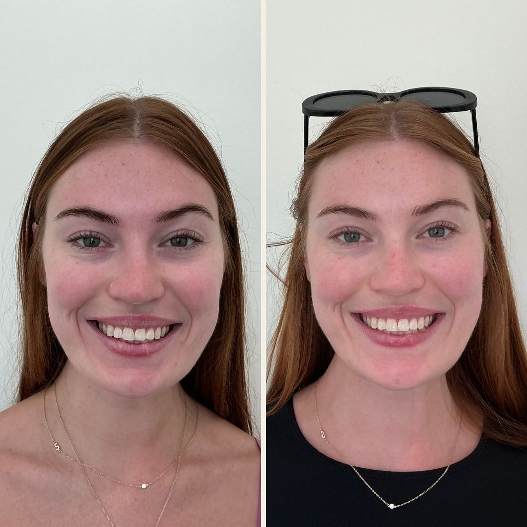 Botox before and after results at Self Skin Studio in Wilmington NC