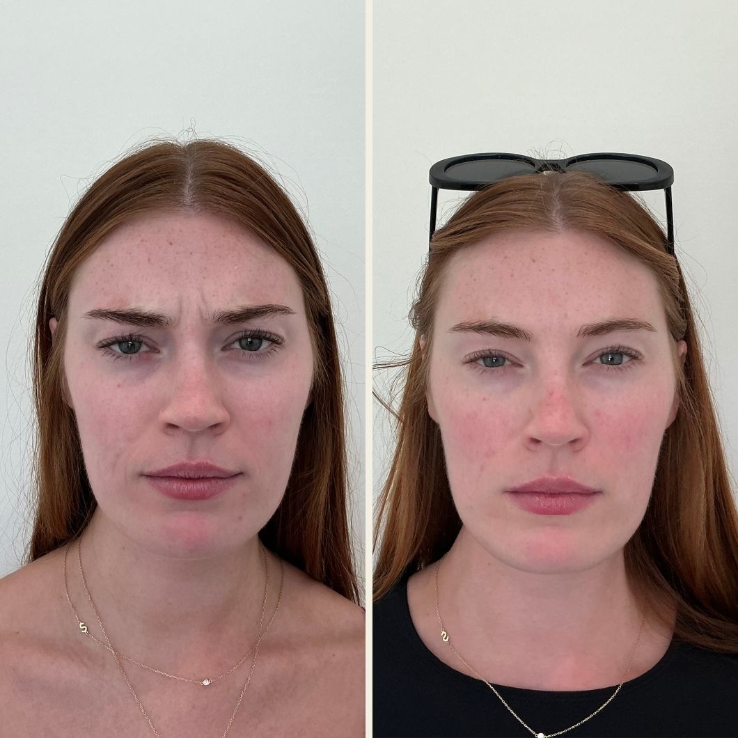 Botox results at Self Skin Studio in Wilmington NC