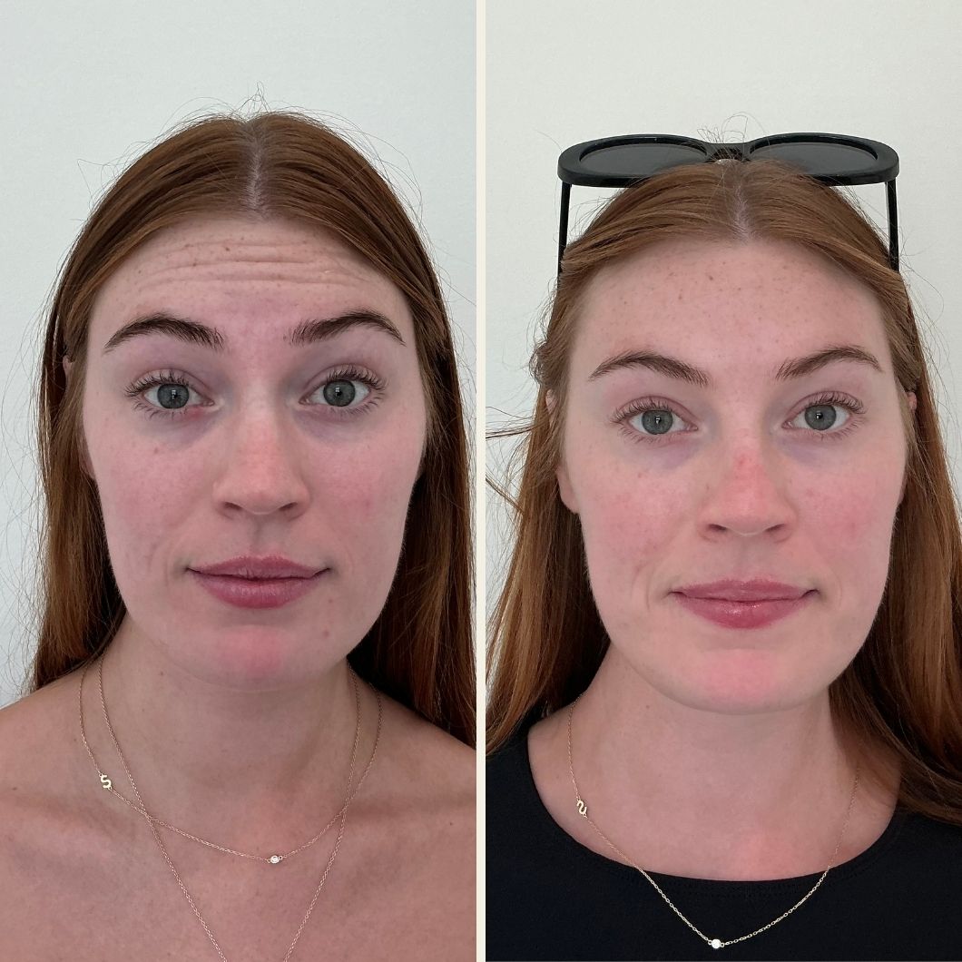 Botox before and after results at Self Skin Studio in Wilmington NC