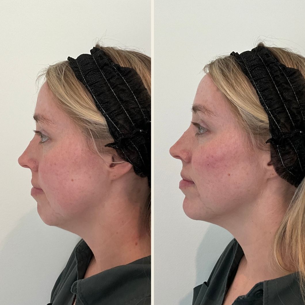 chin filler results at Self Skin Studio in Wilmington, NC