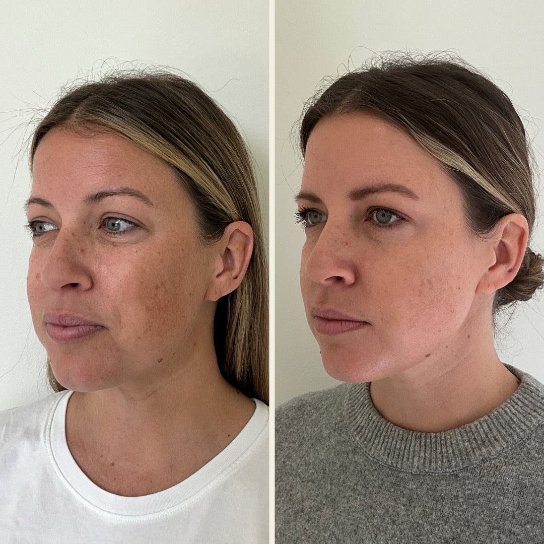 Before and after results of a chemical peel treatment at Self Skin Studio in Wilmington, NC