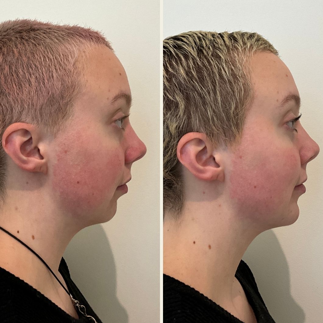 chin and cheek filler results at Self Skin Studio in Wilmington, NC