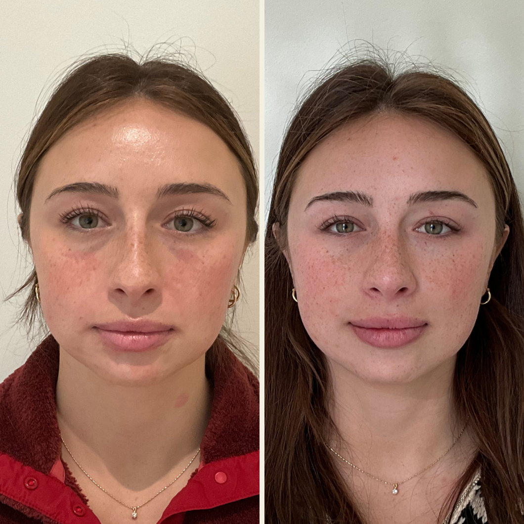 cheek filler at self skin studio in Wilmington, nc